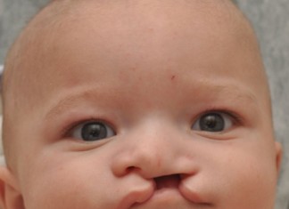 ΧΕΙΛΕΙΟΓΝΑΘΟΥΠΕΡΩΣΧΙΣΤΙΑ (ΣΧΙΣΤΙΕΣ)